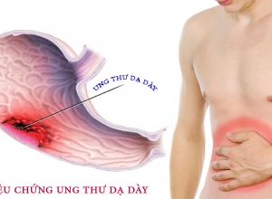 Những triệu chứng báo hiệu ung thư dạ dày bạn không nên bỏ qua